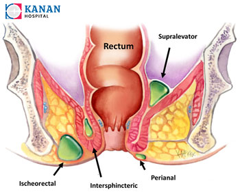 Dr Sanjay Vyas - Anal & Perianal Surgery