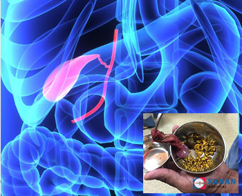 Gallbladder-Stone-Removal-Doctor-in-Ahmedabad-Gujarat-Rajasthan-KananHospital