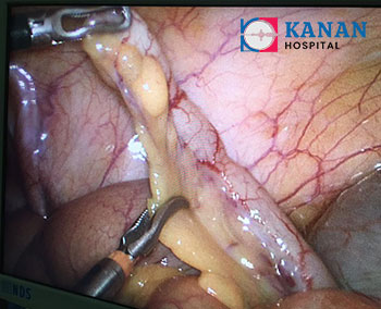 laparoscopic appendix surgeon in ahmedabad dr sanjay vyas
